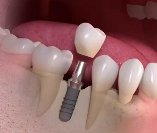 Qu'est ce qu'un implant dentaire?