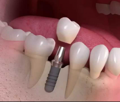 implant dentaire unitaire avec pilier en place